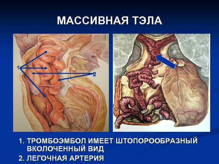 Тромбоз бедра фото