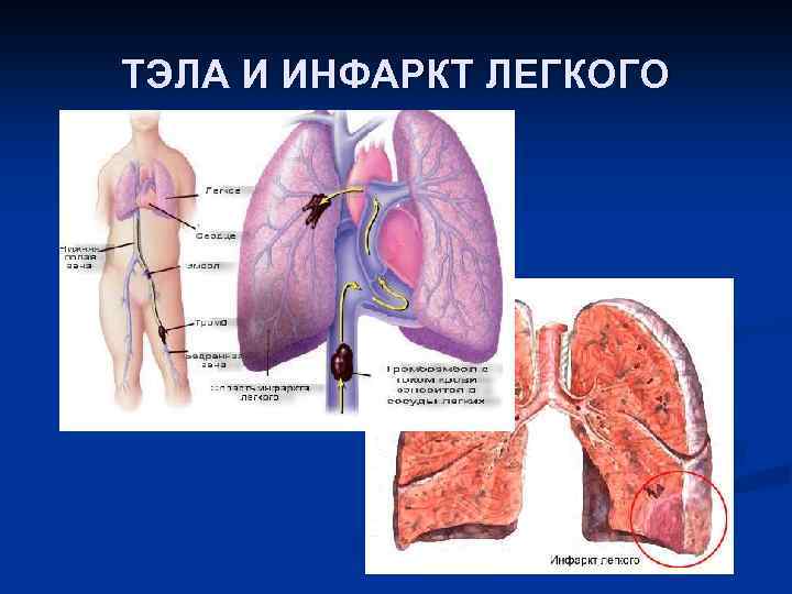 Легочная эмболия инфаркт легкого. Инфаркт легкого при Тэла.