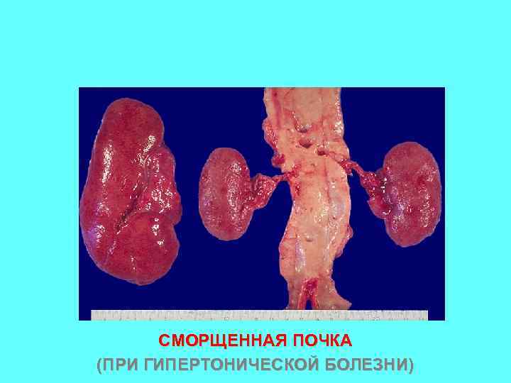 СМОРЩЕННАЯ ПОЧКА (ПРИ ГИПЕРТОНИЧЕСКОЙ БОЛЕЗНИ) 