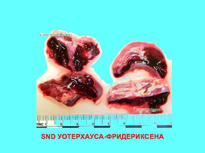 SND УОТЕРХАУСА-ФРИДЕРИКСЕНА 