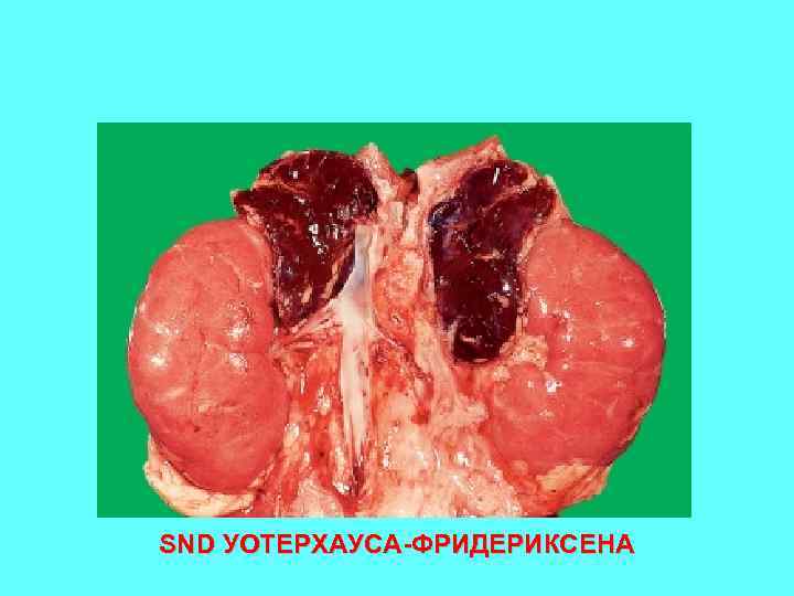 SND УОТЕРХАУСА-ФРИДЕРИКСЕНА 