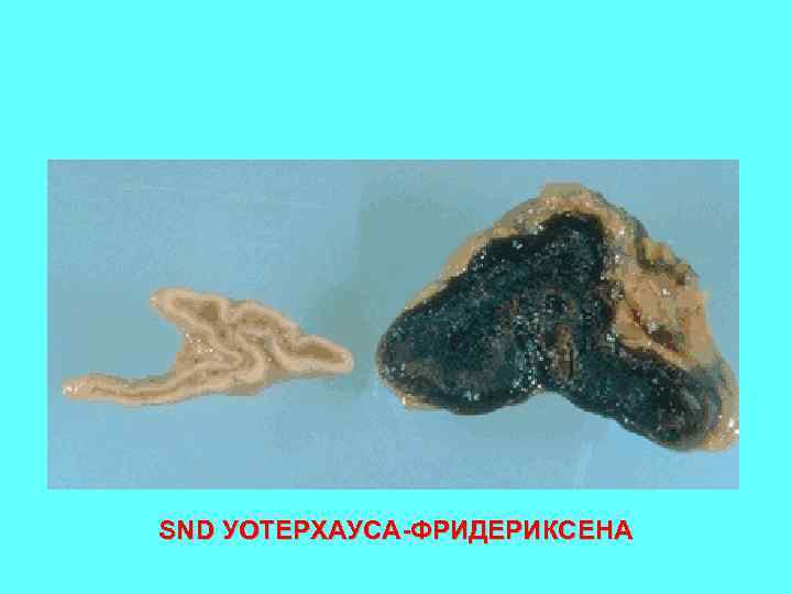 SND УОТЕРХАУСА-ФРИДЕРИКСЕНА 