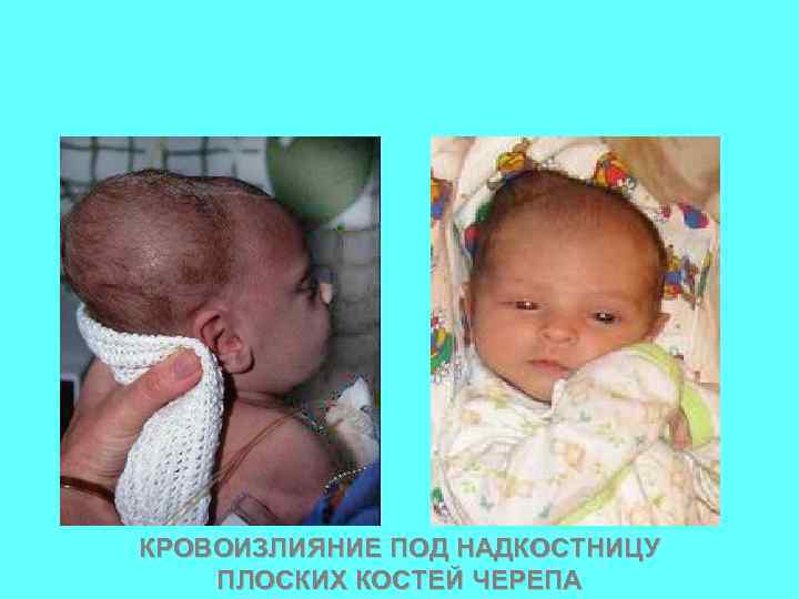 КРОВОИЗЛИЯНИЕ ПОД НАДКОСТНИЦУ ПЛОСКИХ КОСТЕЙ ЧЕРЕПА 