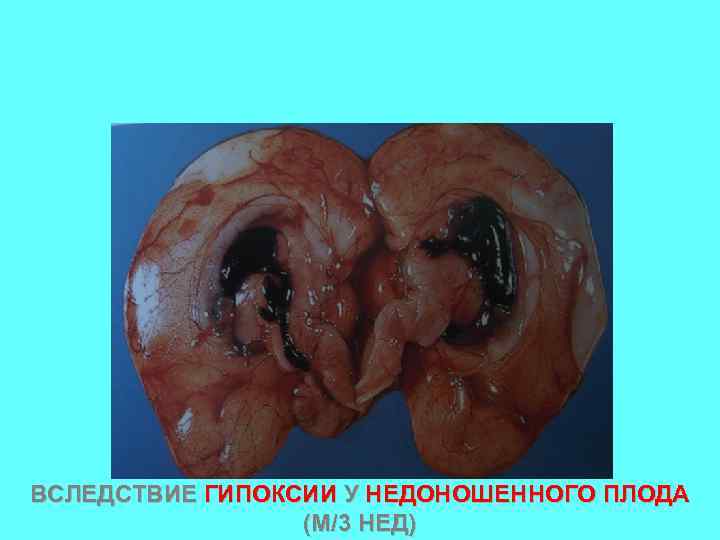 ВСЛЕДСТВИЕ ГИПОКСИИ У НЕДОНОШЕННОГО ПЛОДА (М/3 НЕД) 