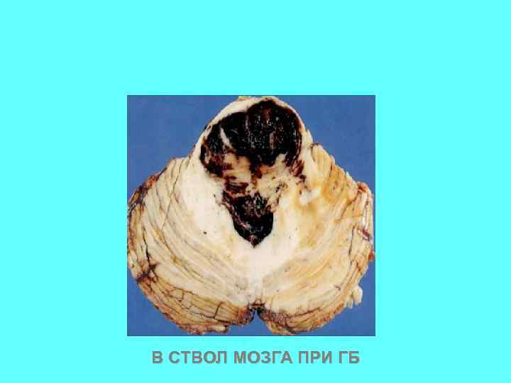 В СТВОЛ МОЗГА ПРИ ГБ 