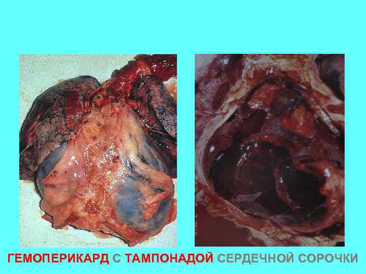 ГЕМОПЕРИКАРД С ТАМПОНАДОЙ СЕРДЕЧНОЙ СОРОЧКИ 