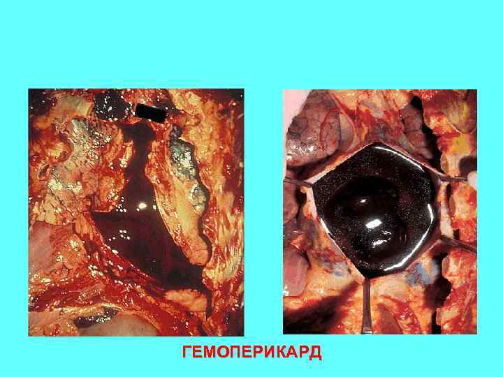 ГЕМОПЕРИКАРД 