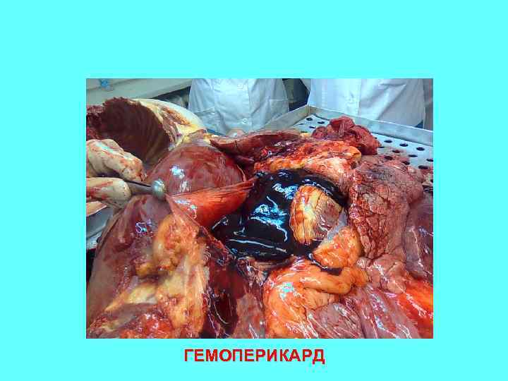 ГЕМОПЕРИКАРД 