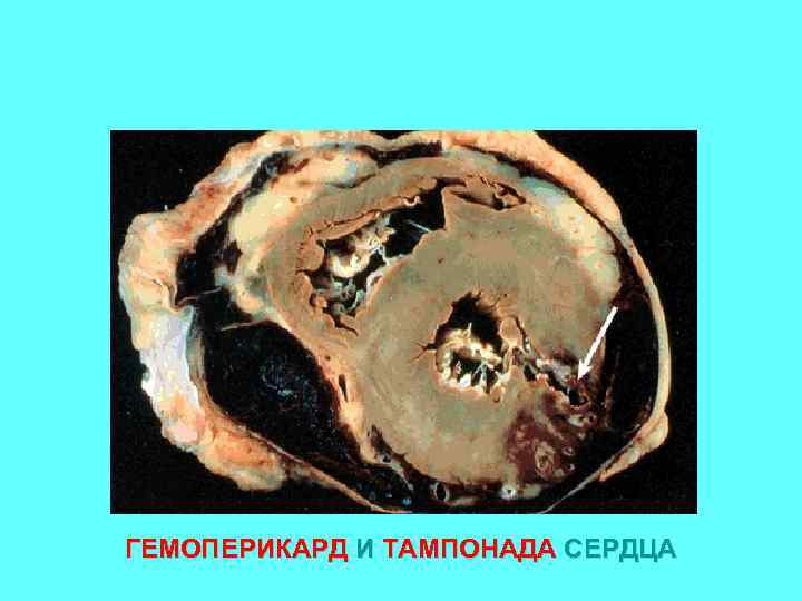 ГЕМОПЕРИКАРД И ТАМПОНАДА СЕРДЦА 