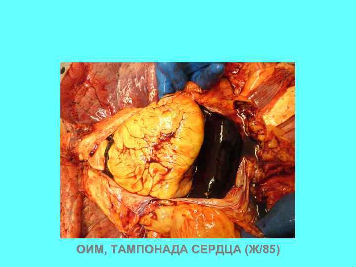 ОИМ, ТАМПОНАДА СЕРДЦА (Ж/85) 