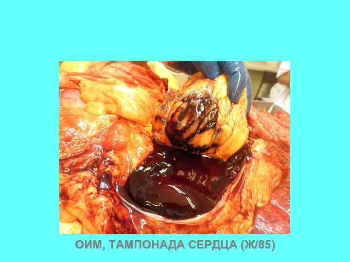 ОИМ, ТАМПОНАДА СЕРДЦА (Ж/85) 