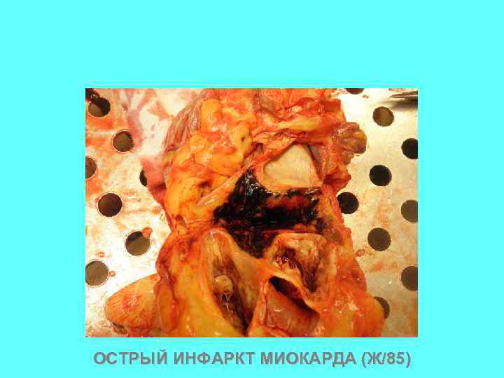 ОСТРЫЙ ИНФАРКТ МИОКАРДА (Ж/85) 