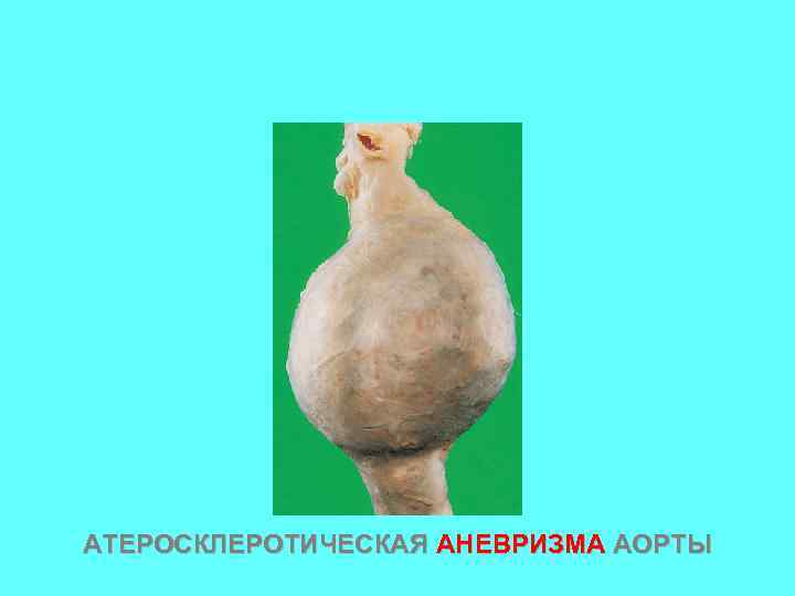 АТЕРОСКЛЕРОТИЧЕСКАЯ АНЕВРИЗМА АОРТЫ 