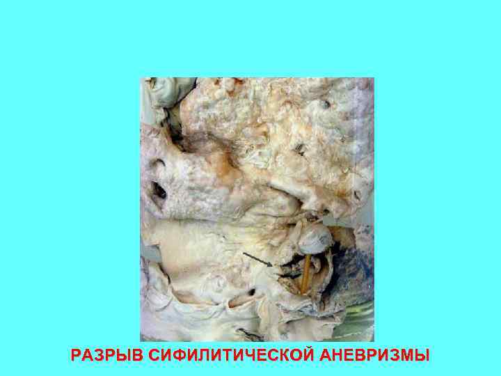 РАЗРЫВ СИФИЛИТИЧЕСКОЙ АНЕВРИЗМЫ 