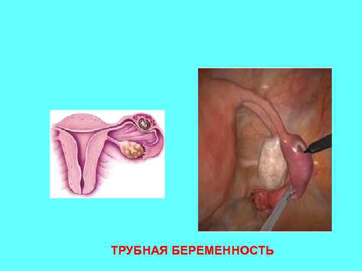 ТРУБНАЯ БЕРЕМЕННОСТЬ 