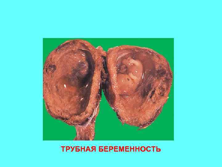 ТРУБНАЯ БЕРЕМЕННОСТЬ 