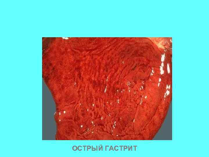 ОСТРЫЙ ГАСТРИТ 