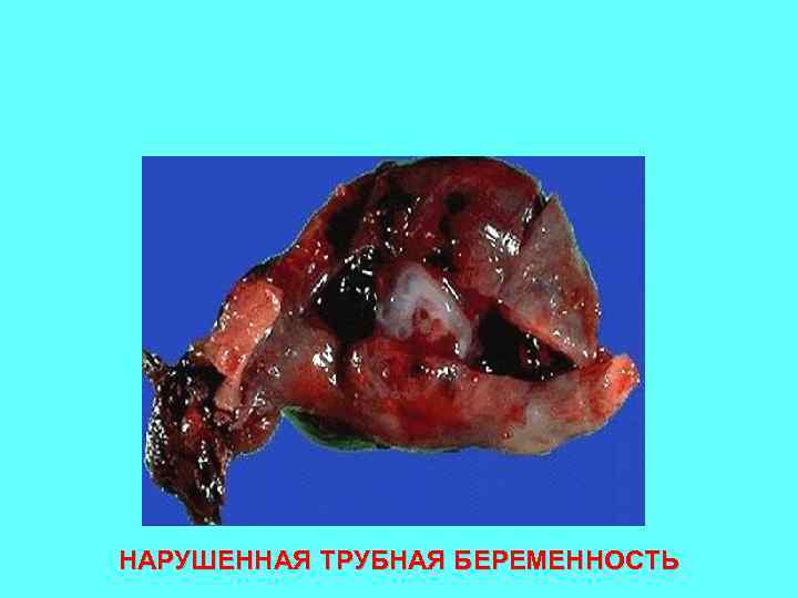 НАРУШЕННАЯ ТРУБНАЯ БЕРЕМЕННОСТЬ 