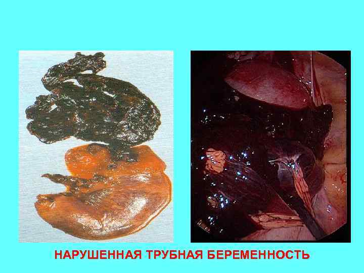 НАРУШЕННАЯ ТРУБНАЯ БЕРЕМЕННОСТЬ 