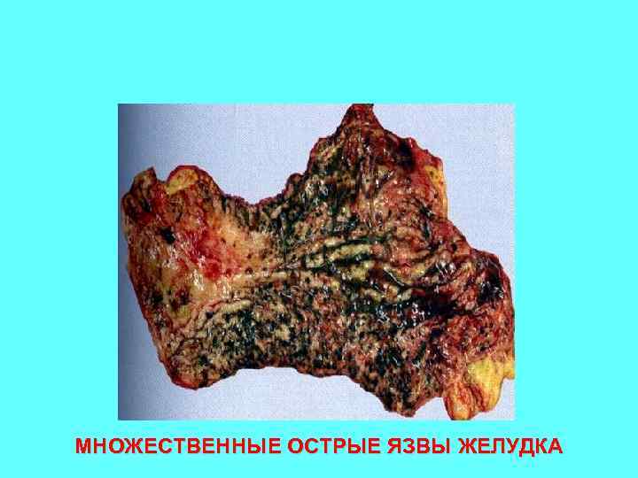 МНОЖЕСТВЕННЫЕ ОСТРЫЕ ЯЗВЫ ЖЕЛУДКА 