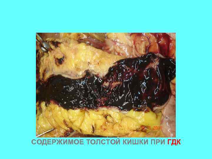 СОДЕРЖИМОЕ ТОЛСТОЙ КИШКИ ПРИ ГДК 