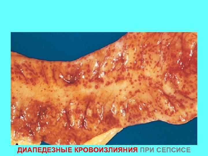 ДИАПЕДЕЗНЫЕ КРОВОИЗЛИЯНИЯ ПРИ СЕПСИСЕ 