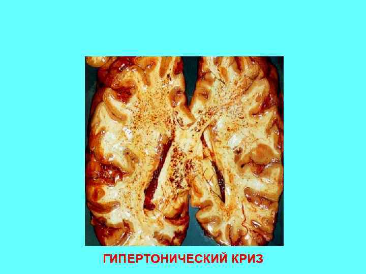 ГИПЕРТОНИЧЕСКИЙ КРИЗ 