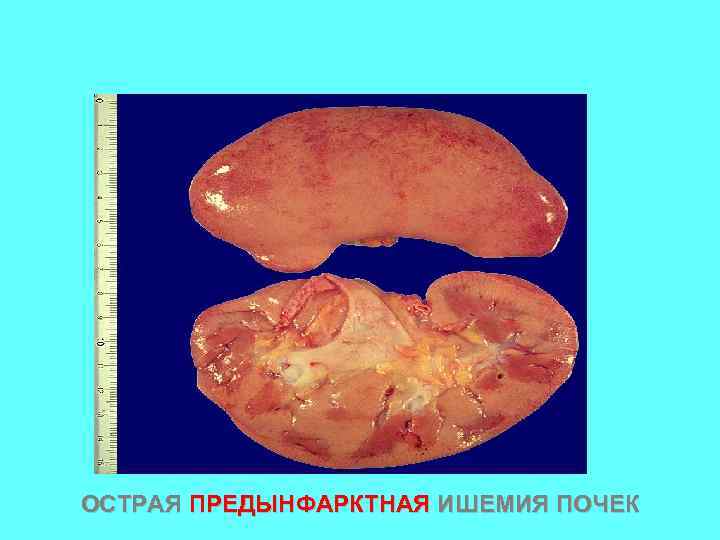 ОСТРАЯ ПРЕДЫНФАРКТНАЯ ИШЕМИЯ ПОЧЕК 