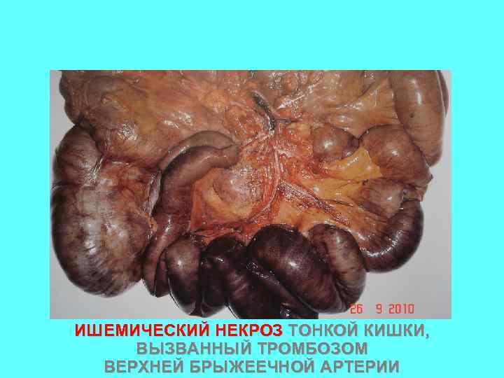 ИШЕМИЧЕСКИЙ НЕКРОЗ ТОНКОЙ КИШКИ, ВЫЗВАННЫЙ ТРОМБОЗОМ ВЕРХНЕЙ БРЫЖЕЕЧНОЙ АРТЕРИИ 