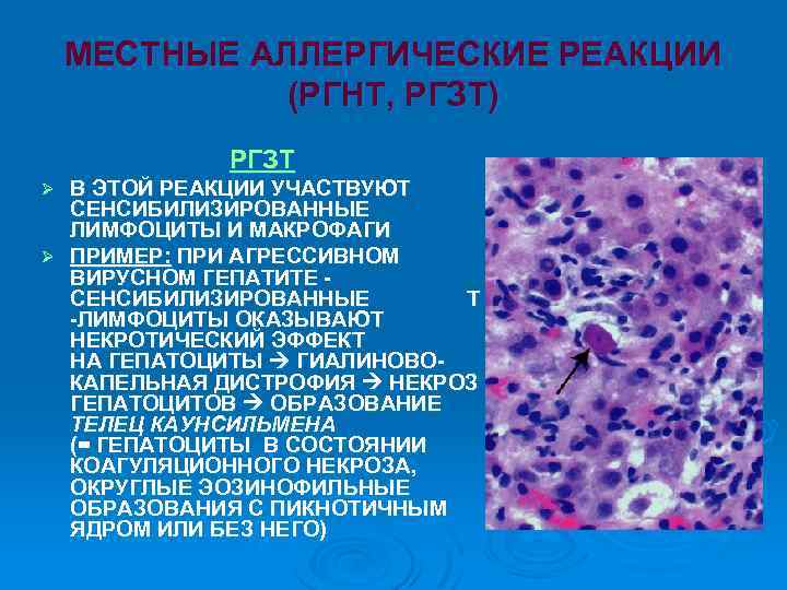 МЕСТНЫЕ АЛЛЕРГИЧЕСКИЕ РЕАКЦИИ (РГНТ, РГЗТ) РГЗТ В ЭТОЙ РЕАКЦИИ УЧАСТВУЮТ СЕНСИБИЛИЗИРОВАННЫЕ ЛИМФОЦИТЫ И МАКРОФАГИ