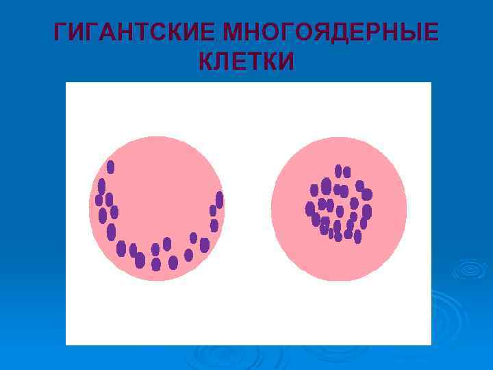 ГИГАНТСКИЕ МНОГОЯДЕРНЫЕ КЛЕТКИ 