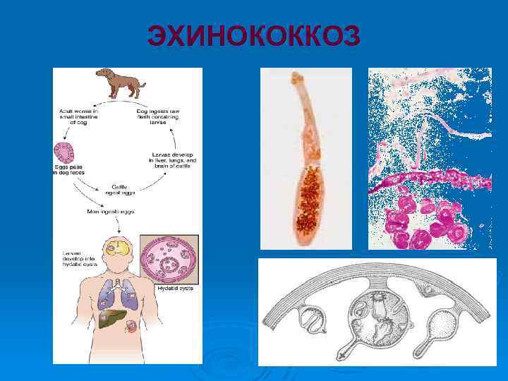 ЭХИНОКОККОЗ 