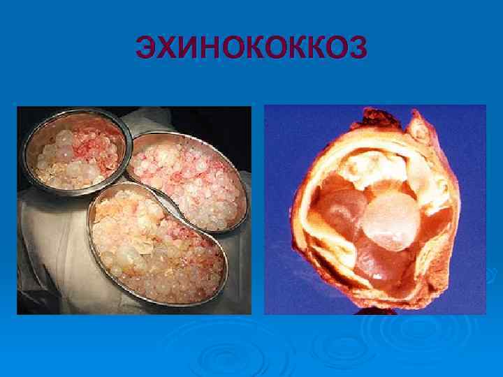 ЭХИНОКОККОЗ 