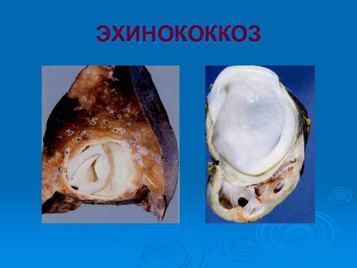 ЭХИНОКОККОЗ 