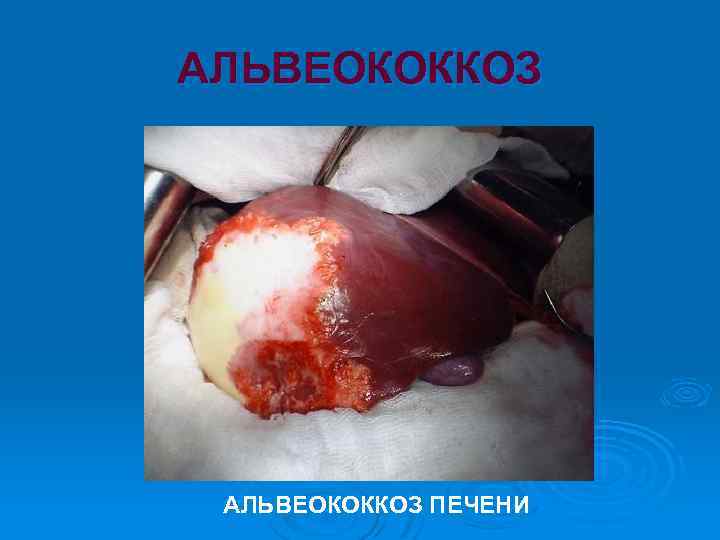 АЛЬВЕОКОККОЗ ПЕЧЕНИ 