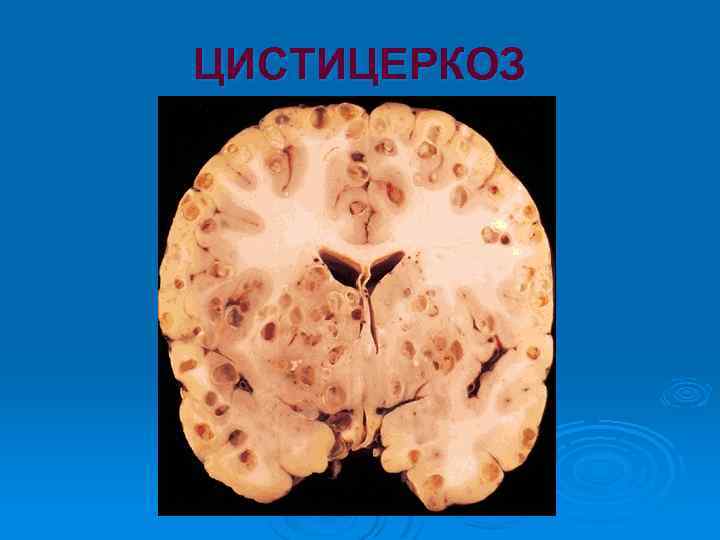 ЦИСТИЦЕРКОЗ 