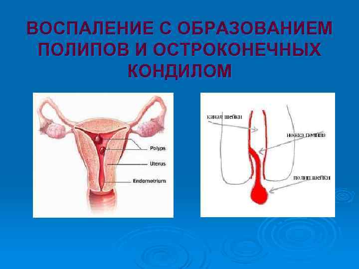 ВОСПАЛЕНИЕ С ОБРАЗОВАНИЕМ ПОЛИПОВ И ОСТРОКОНЕЧНЫХ КОНДИЛОМ 