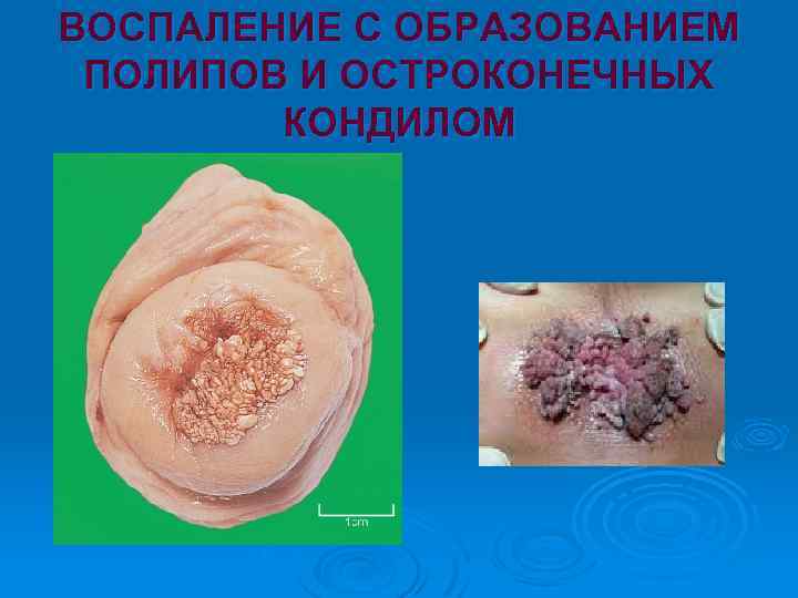 ВОСПАЛЕНИЕ С ОБРАЗОВАНИЕМ ПОЛИПОВ И ОСТРОКОНЕЧНЫХ КОНДИЛОМ 