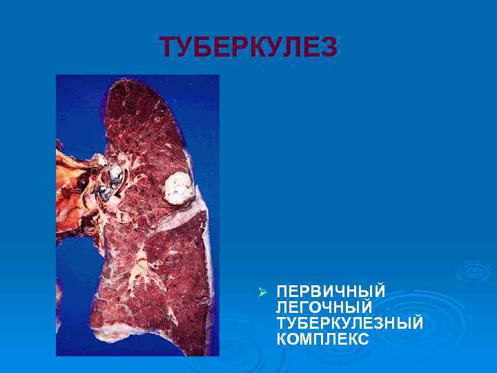 ТУБЕРКУЛЕЗ Ø ПЕРВИЧНЫЙ ЛЕГОЧНЫЙ ТУБЕРКУЛЕЗНЫЙ КОМПЛЕКС 