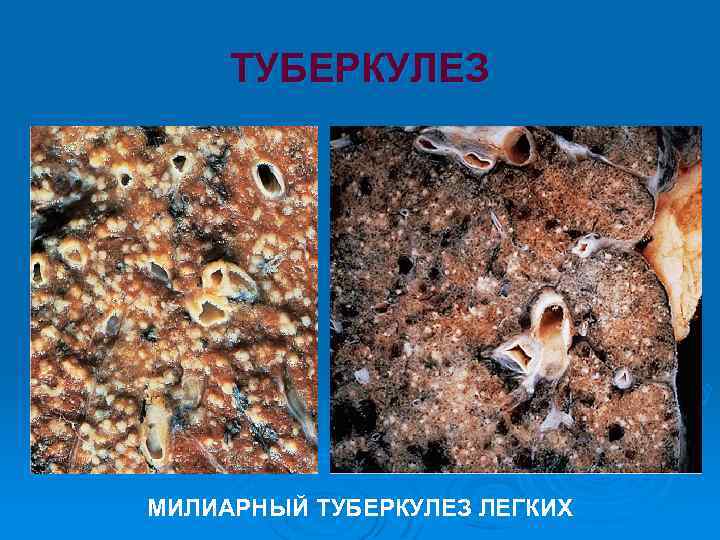 ТУБЕРКУЛЕЗ МИЛИАРНЫЙ ТУБЕРКУЛЕЗ ЛЕГКИХ 