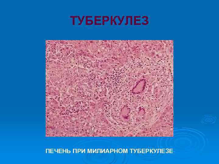ТУБЕРКУЛЕЗ ПЕЧЕНЬ ПРИ МИЛИАРНОМ ТУБЕРКУЛЕЗЕ 