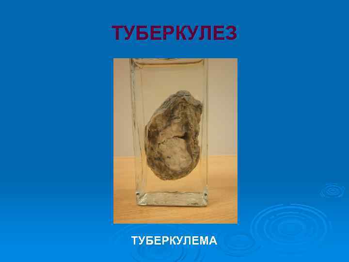 ТУБЕРКУЛЕЗ ТУБЕРКУЛЕМА 