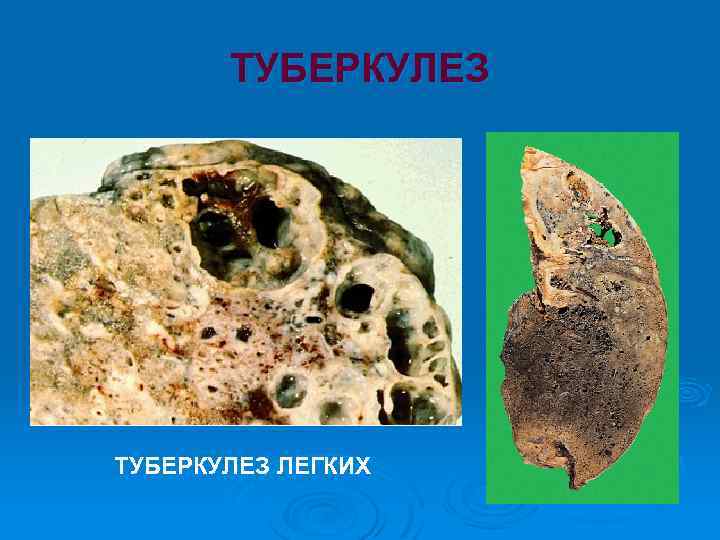 ТУБЕРКУЛЕЗ ЛЕГКИХ 