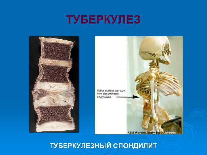 ТУБЕРКУЛЕЗНЫЙ СПОНДИЛИТ 