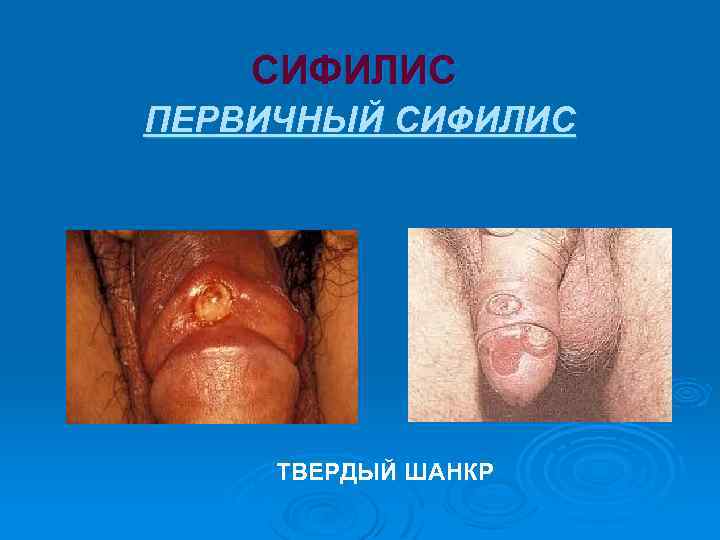 СИФИЛИС ПЕРВИЧНЫЙ СИФИЛИС ТВЕРДЫЙ ШАНКР 