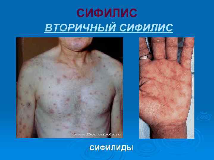 СИФИЛИС ВТОРИЧНЫЙ СИФИЛИС СИФИЛИДЫ 