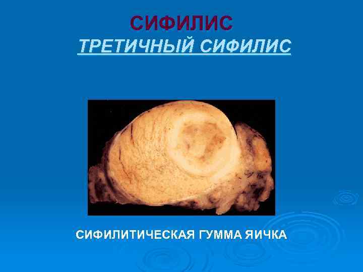 СИФИЛИС ТРЕТИЧНЫЙ СИФИЛИС СИФИЛИТИЧЕСКАЯ ГУММА ЯИЧКА 