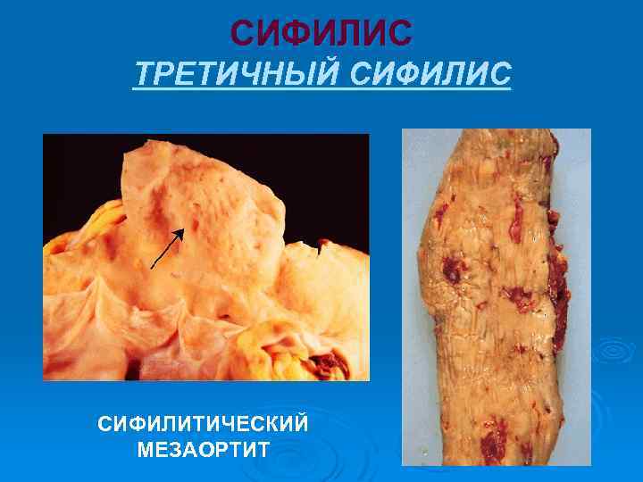 СИФИЛИС ТРЕТИЧНЫЙ СИФИЛИС СИФИЛИТИЧЕСКИЙ МЕЗАОРТИТ 