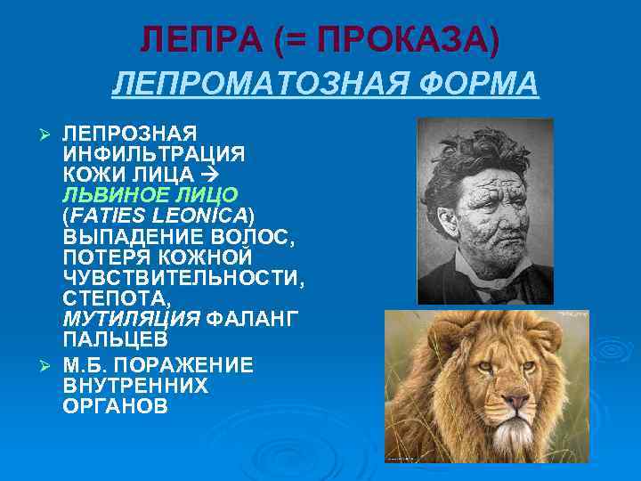 ЛЕПРА (= ПРОКАЗА) ЛЕПРОМАТОЗНАЯ ФОРМА ЛЕПРОЗНАЯ ИНФИЛЬТРАЦИЯ КОЖИ ЛИЦА ЛЬВИНОЕ ЛИЦО (FATIES LEONICA) ВЫПАДЕНИЕ