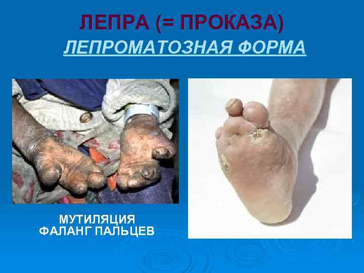 ЛЕПРА (= ПРОКАЗА) ЛЕПРОМАТОЗНАЯ ФОРМА МУТИЛЯЦИЯ ФАЛАНГ ПАЛЬЦЕВ 